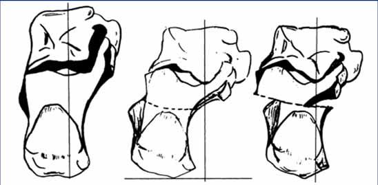 CLASSIC MEDIALIZING OSTEOTOMY CONCEPT HAS NOT MUCH CHANGED To correct deformities in the frontal plane Effective for patients with marked