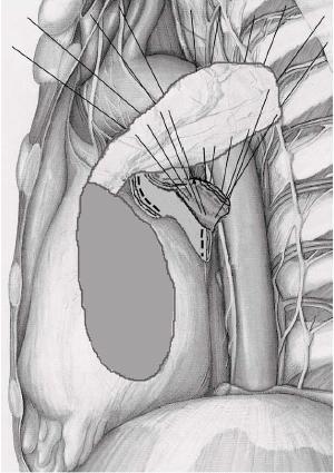 patients, the resulting defect in the pericardium was not reconstructed.