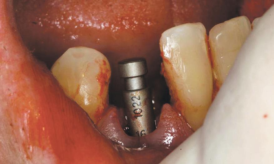 The patient opted for a single-tooth implant with a cemented restoration. Both clinical and radiographic examinations revealed no signs of active infection. Probing depths were within normal limits.