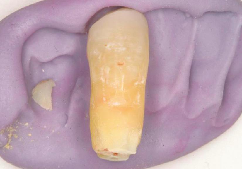 The patient s extracted tooth was to serve as the provisional restoration while healing occurred (Figure 4).