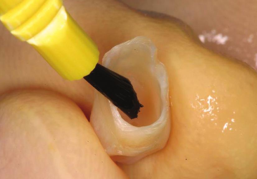 A thin layer of Zone temporary cement (Dux Dental, Oxnard, California, USA) was placed in the provisional (Figure 16), which was then put on the laboratory analog to remove the excess cement prior