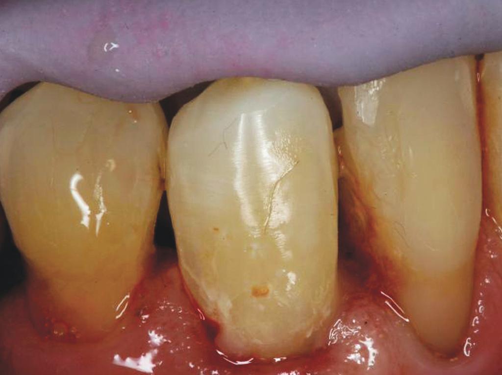 NATURAL TOOTH AS A PROVISIONAL FOLLOWING