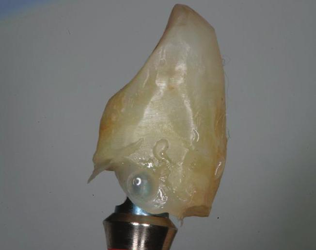 An implant analog with corresponding abutment