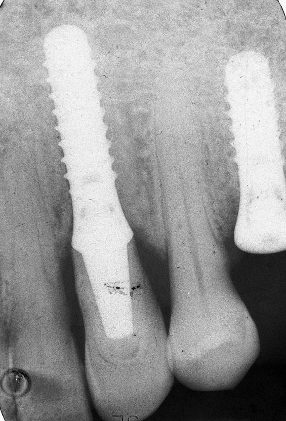 NATURAL TOOTH AS A PROVISIONAL FOLLOWING IMPLANT PLACEMENT (Figure 23) reveals a perfect fit of the provisional restoration. The placement of the final restoration could begin.