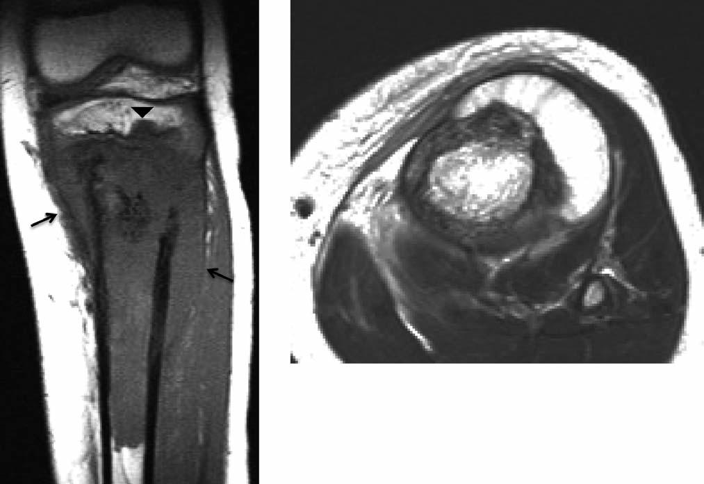 Futani et al: Successful Treatment of Small Cell Osteosarcoma Figure 3.