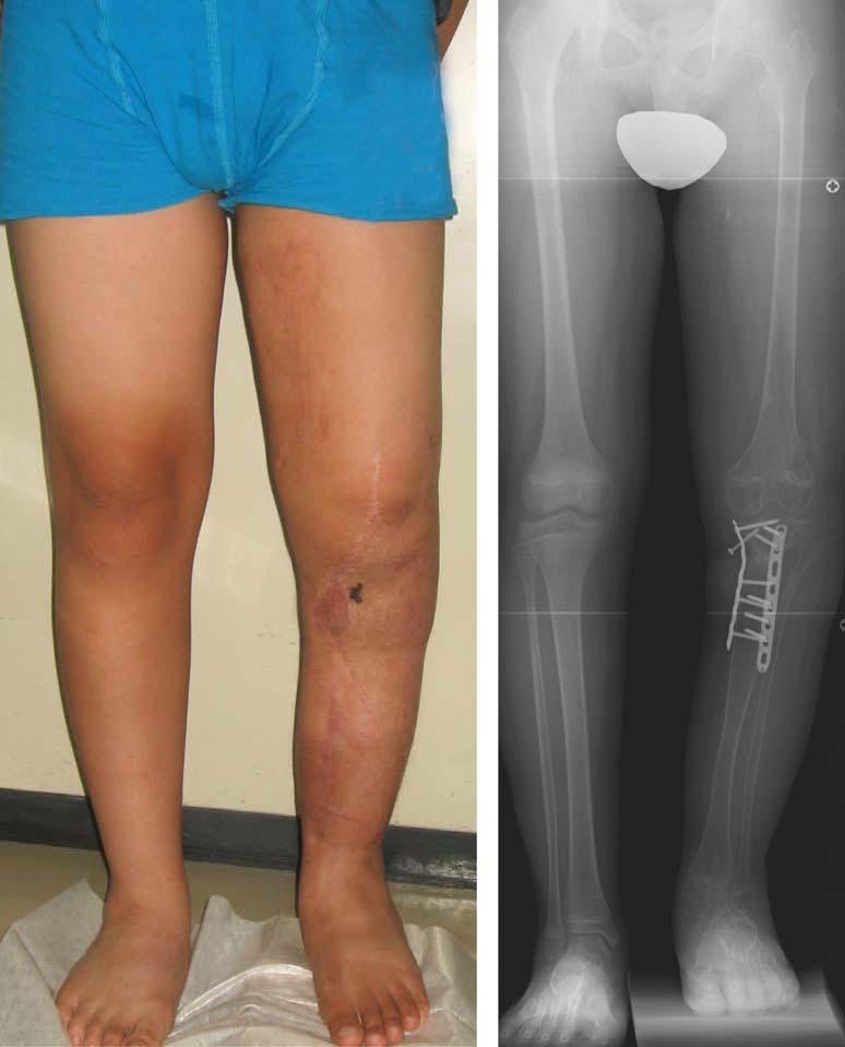 Figure 8. At 4 years after the surgery, the patient has leg length discrepancy of 3 cm (left).