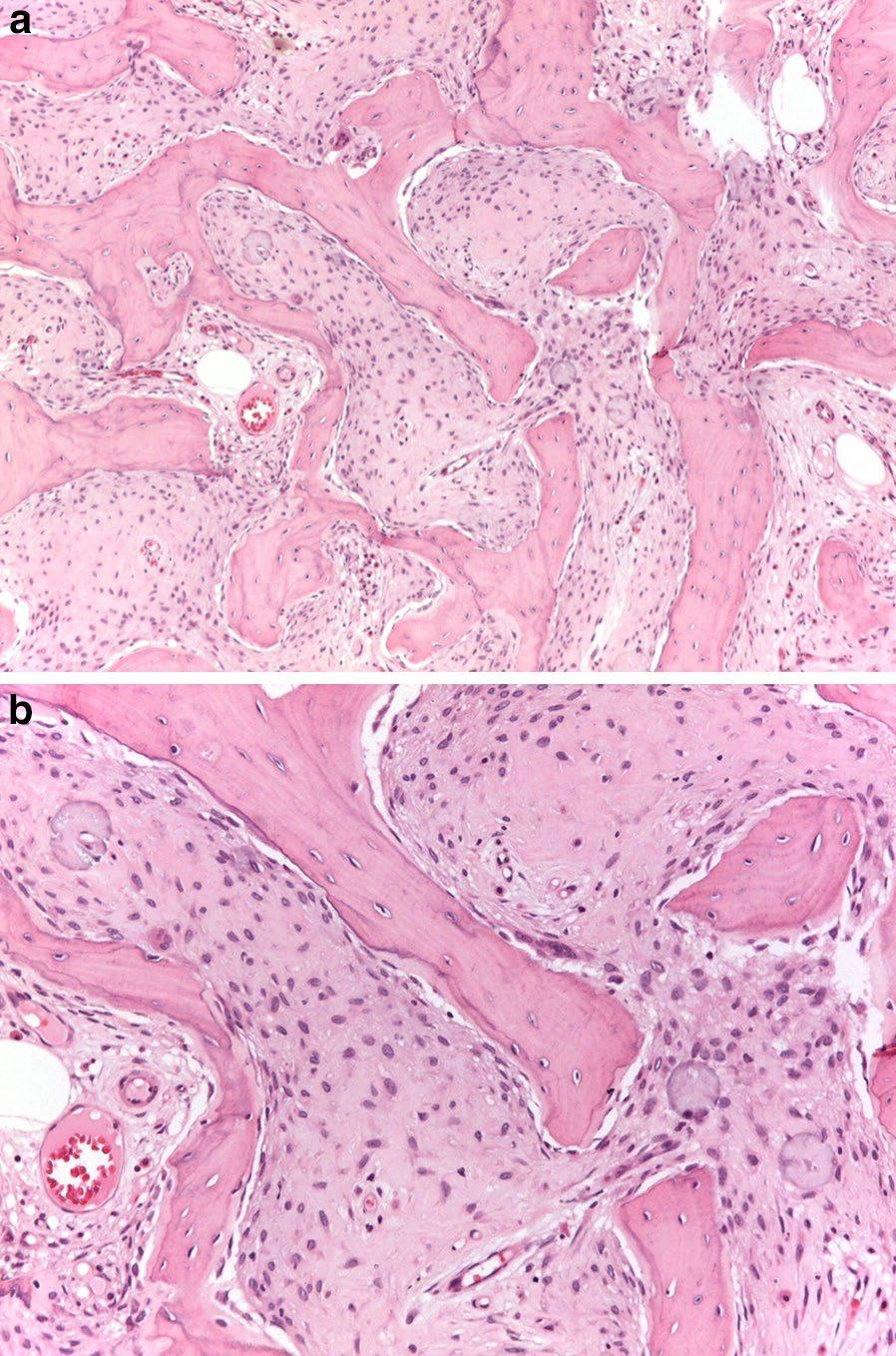 Righi et al. Clin Sarcoma Res (2015) 5:23 Page 3 of 6 Fig. 1 a, b A low grade (grade 2) fibroblastic osteosarcoma, fibrous dysplasia-like variant (case no.