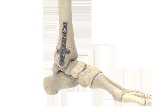 LPL Medial Tibia Plates Surgical Technique [continued] 5 Insert Remaining Screws Complete the reduction and the stabilization of the fracture. Insert the remaining screws as previously described.