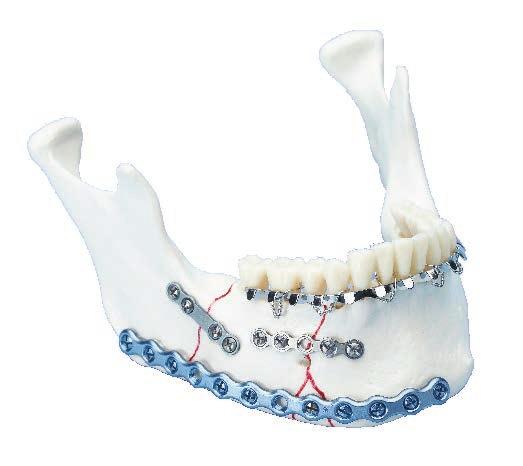 MatrixMANDIBLE PLATING SYSTEM Comprehensive anatomic locking plate selection in a single streamlined set Surgical fracture treatment and reconstruction aim at restoring bony anatomy and function.