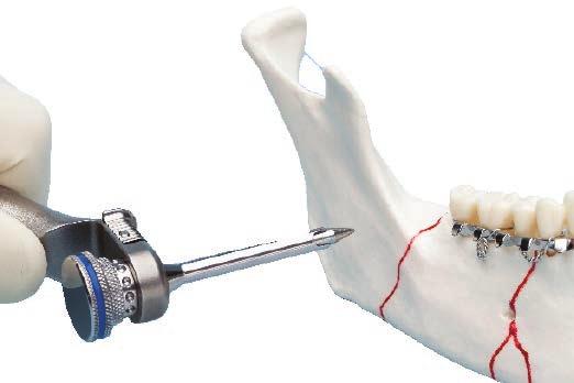 0 mm Cannula and Obturator The cannula and obturator may be used with any mandibular approach.