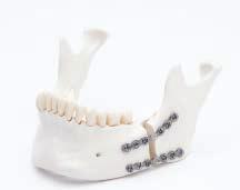 Indications/Contraindications Indications The DePuy Synthes CMF MatrixMANDIBLE Plating System is