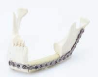 5 mm small reconstruction plates*: Primary mandibular Comminuted fractures Single-angle reconstruction (used with
