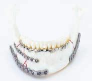 0 mm small reconstruction plates: Primary mandibular Comminuted fractures Single-angle reconstruction (used with
