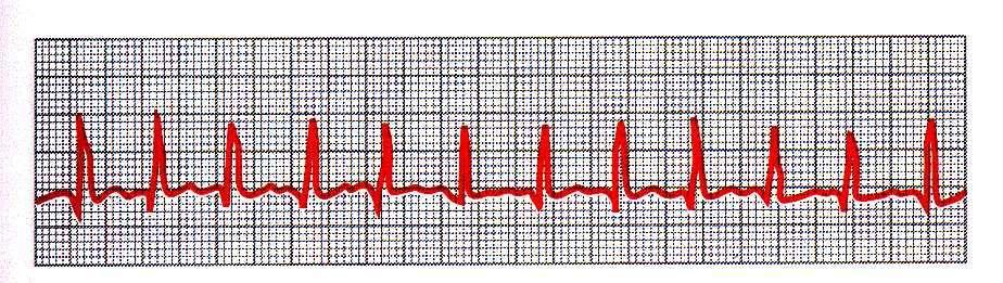 Abnormal Sinus Rhythms Tachycardia means a fast heart rate usually greater than 100 beats /min.