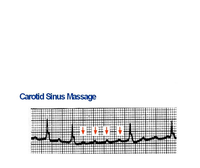 Atrial Flutter Diagnosis Look for flutter waves Be suspicious if rate is near 150 If not sure, can use vagal maneuvers or 6 mg of IV Adenosine to slow AV