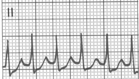 AVRT Diagnosis Need to know about preexcitation on baseline EKG NSR with V
