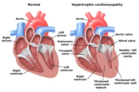 What is Cardiomyopathy?