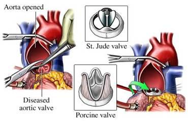 Aortic Stenosis Treatment of Symptomatic Aortic Stenosis or Decreased LV Function Medical