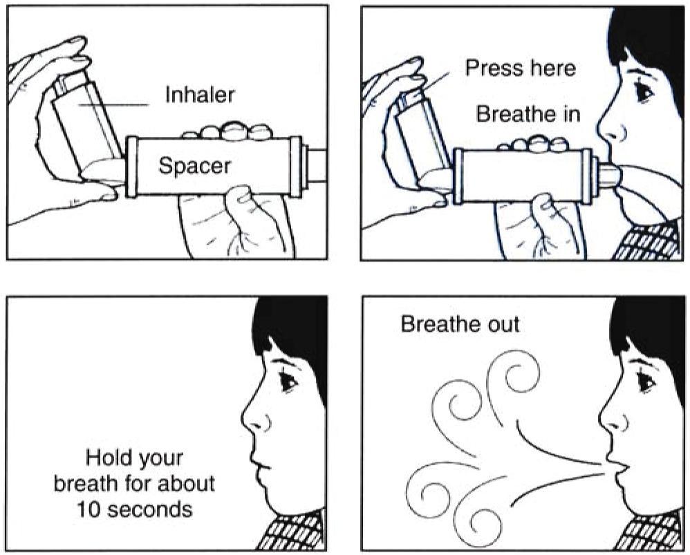 This will help reduce the chances of thrush. To properly use a spacer, follow these steps: 1. Put the spacer on the inhaler. Shake well. 2. Breathe out normally. 3. Press down 1 time on the inhaler.
