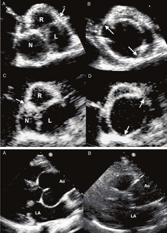 Otto CM Figure 1. (A) Basic morphologies of bicuspid aortic valve (BAV). Panel A shows a typical BAV in diastole with a small raphe (arrow) between the right (R) and left (L) coronary cusps.