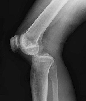 dislocation with either cruciate intact Bicruciate injury with collaterals intact Bicruciate injury, one collateral ligament injury KDIIM bicruciate with medial collateral ligament injury