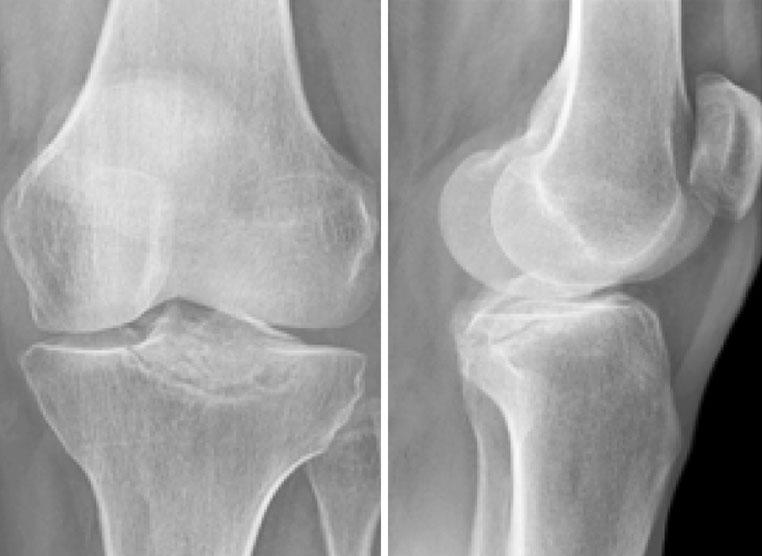Knee Surg Sports Traumatol Arthrosc (2010) 18:1612 1616 1613 Case report A 57-year-old woman presented to the orthopaedic outpatient clinic.