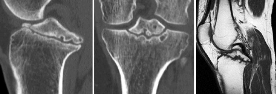 1614 Knee Surg Sports Traumatol Arthrosc (2010) 18:1612 1616 Fig. 2 Computed tomography revealing a large bony avulsion of the tibial attachment of the PCL.