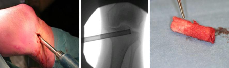 Removed pseudo-arthrosis shows the fibrous tissue and healthy cancellous bone Using a curette through the drill-hole, the remaining pseudo-arthrosis was removed under fluoroscopic control (Fig. 4).