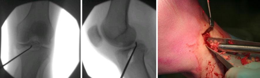 A tibial ACL guide was used to guide Kirschner wires for two 4.5- mm cannulated partially threaded screws. These screws were used to lag and stabilize the bony fragment.