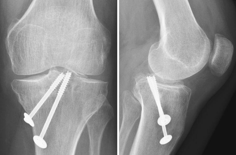 Knee Surg Sports Traumatol Arthrosc (2010) 18:1612 1616 1615 Fig.