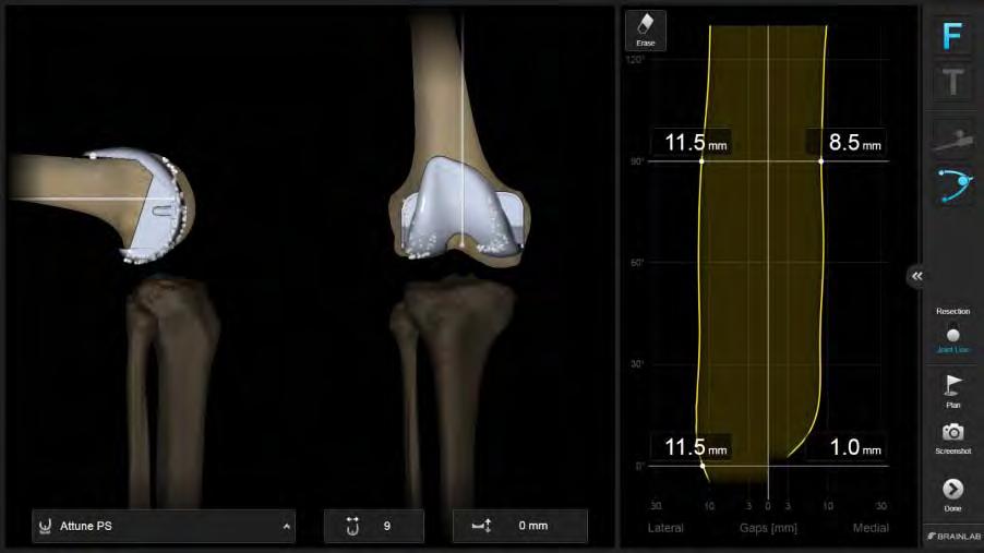 KNEE 3 - Initial Alignment Initially registered 12 varus (extension