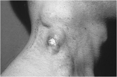 Manifestations of TB Related IRIS Common manifestations: New or worsening lymphadenopathy, including