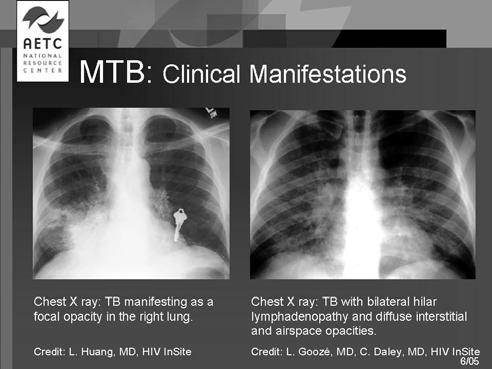 these patients high, with high rate of disseminated disease and + mycobacterial blood cultures Differences in CXR appearance of pulmonary TB in advanced HIV infection Pulmonary TB in Advanced HIV