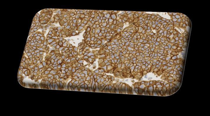 IHC is scored according to the number of tumor cells that have their membrane stained.