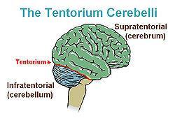 Childhood Brain Tumors Tentorium - extension of the dura mater separating the cerebellum from the occipital lobes 27 50% of childhood brain and CNS tumors are infratentorial, originating below the