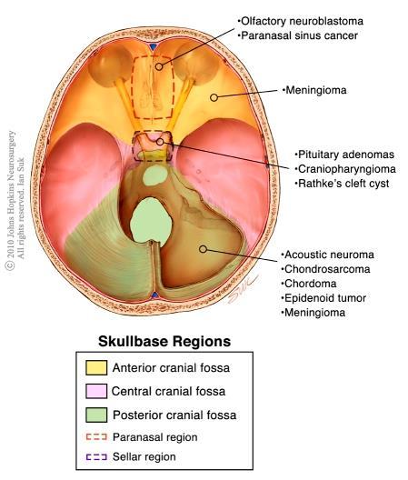 Sinus, Olfactory, Base of Skull Tumors 51 http://www.hopkinsmedicine.org/sebin/d/w/skull-base-ian-suk-sml.jpg Histologic Type - Glioma Most common category of primary brain tumors.