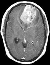 Brain Stem Glioma Juvenile Pilocytic