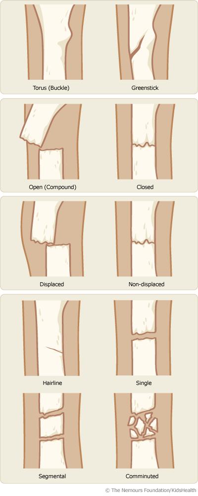 Different Types of Fractures A doctor might be able to tell whether a bone is broken simply by looking at the injured area.