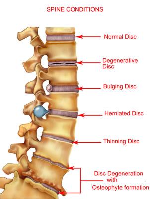 Disorders of the Spine. (What about My Discs?) Discs have two parts the hard outer part called the annulus and softer jelly-like inner part called the nucleus.