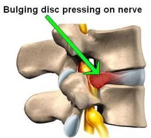 There are two common Disc problems we see in our Chiropractic clinic: Bulging Discs are common problem were a weakened area of the annulus (fibrous tissue) allows the softer jelly-like nucleus of the