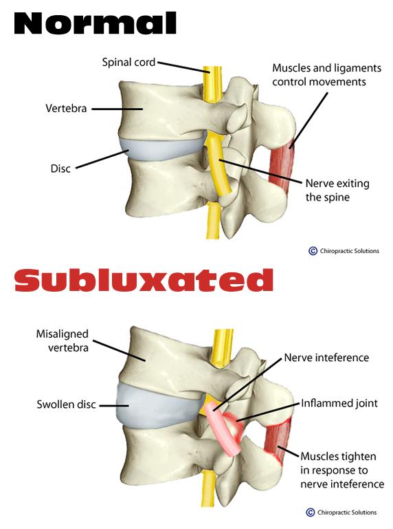 What is a spinal subluxation?