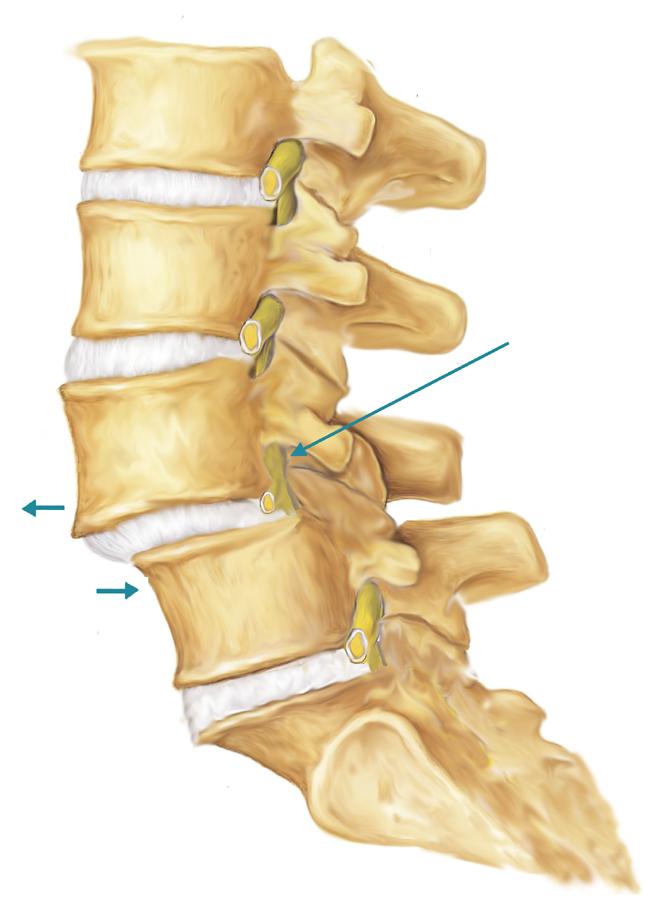 Spondylolisthesis Spondylolisthesis occurs when one vertebra slips forward on the adjacent