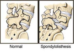 Scoliosis Scoliosis is an abnormal curving of the spine. Your spine is your backbone.