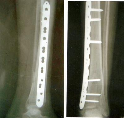 Figure 4 Figure 6 Fig 4: Radiological union lateral view (left) and AP View (Right) Fig 6: Photographs showing full weight bearing (Left) and Squatting (Right) Post-operatively limb was kept