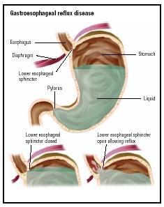 No anatomic sphincter exists at the lower end of the esophagus However, the circular layer of smooth muscle in this region serves as a physiologic sphincter As the food descends through the