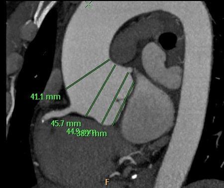 VHD CT Rule out coronary disease before valvular