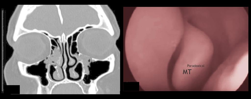 and frontal sinuses that are inflamed; obliterated ipsilateral ostiomeatal complex is also seen. (C) Endoscopic images revealed huge left concha bullosa. Figure 8.