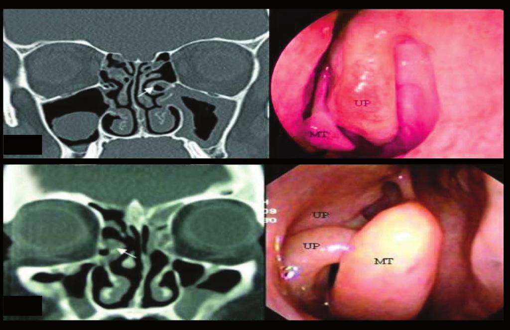 and bilateral concha bullosa. () Endoscopic image shows medially deviated right-sided uncinate process (UP) and concha bullosa (C). Figure 10. Two different cases.