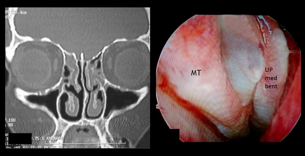 Original rticle Pol J Radiol, 2017; 82: 713-725 Figure 11. () MSCT, coronal scan of PNS shows a left-sided, medially deviated uncinate process associated with bilateral ethmoidal sinusitis.