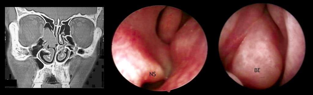 () Endoscopic image revealed the same findings of right bony nasal septal spur (NS). C Figure 2.